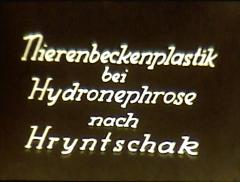 Nierenbeckenplastik bei Hydronephrose nach Hryntschak