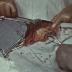 Operative Behandlung erfrorener Füsse / Operation einer Cystenniere