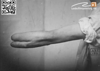 Ohnhänderfilm. Erster Weltkrieg Männer mit Krukenberg-Zange und Armprothese in Alltagssituationen